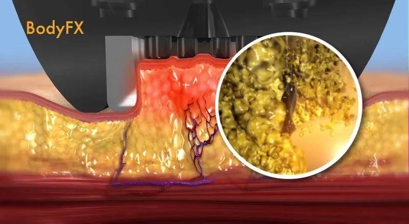 Body FX — how the treatment works