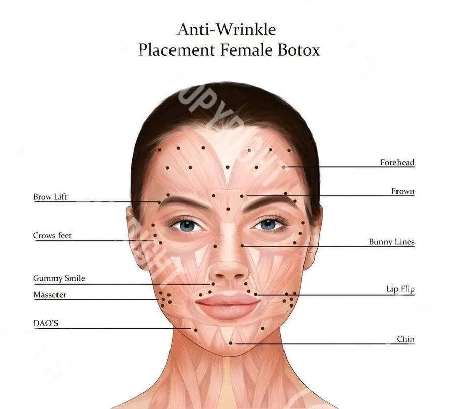 Botox anti-wrinkle injection placement map — forehead, frown, crows feet, and more