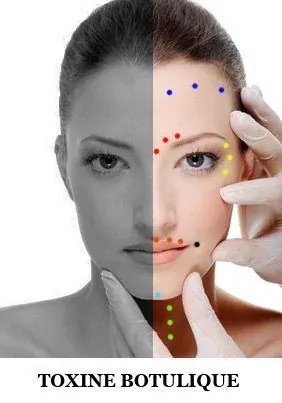 Facial Botox injection points diagram