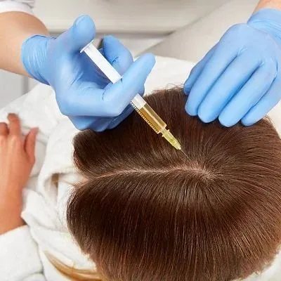 Exosome therapy for hairline and density
