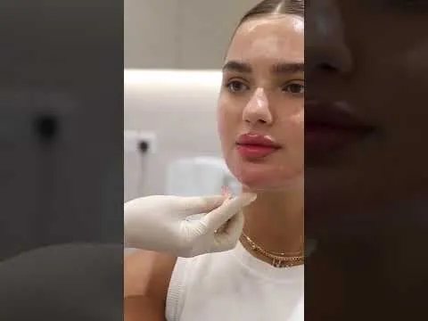 Dermal filler results video at Hollywood Clinic