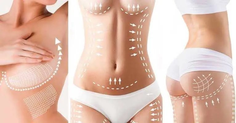 HIFU Body treatment areas — arms, abdomen and buttocks
