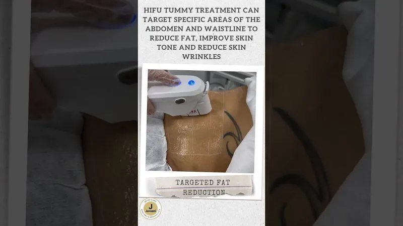HIFU Body — how focused ultrasound works