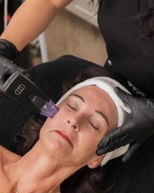Morpheus8 applicator on the cheek for skin remodeling