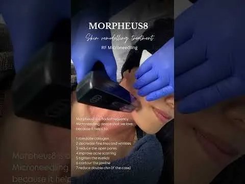 Morpheus8 treatment video at Hollywood Clinic
