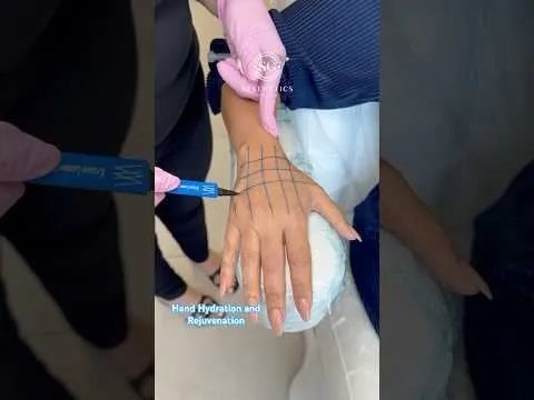 Skin booster session video at Hollywood Clinic