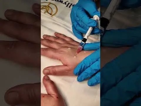 Skin booster results video at Hollywood Clinic